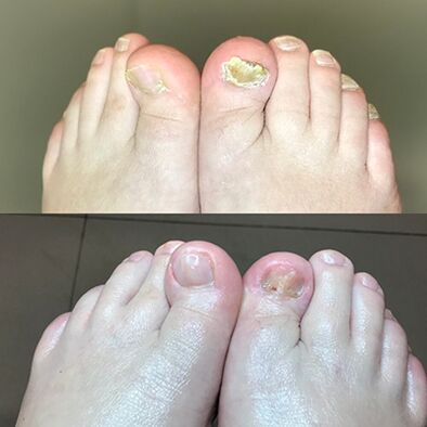 Doświadczenie w użyciu kremowych barnab z Izraela, zdjęcie przed i po