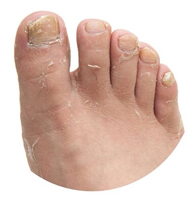 Przyczyny grzyba stóp