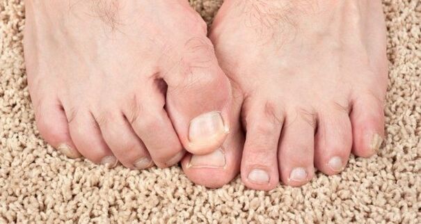 Objawy grzyba paznokci