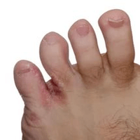 grzyb między palcami