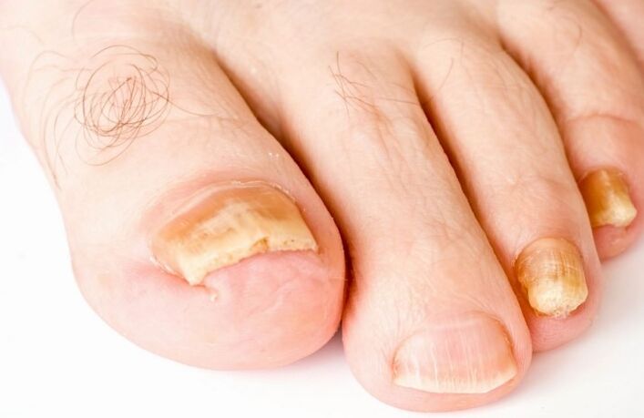 Grzyb na kciuku nogi