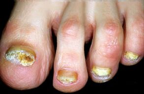 Charakterystyka choroby