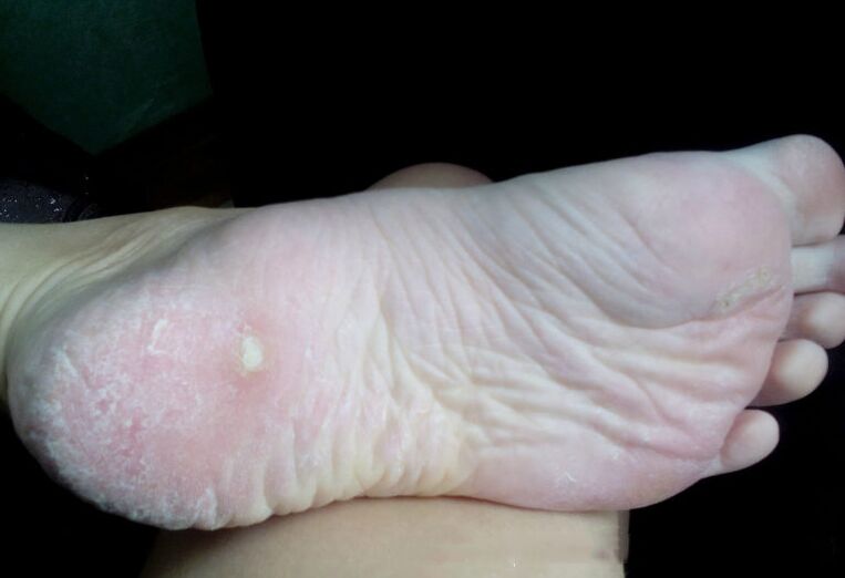 Leczenie grzyba laserem