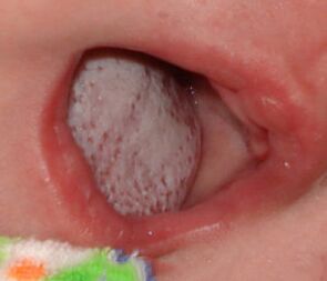 Lokalizacja choroby z grzybem