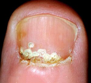 Objawy i oznaki choroby