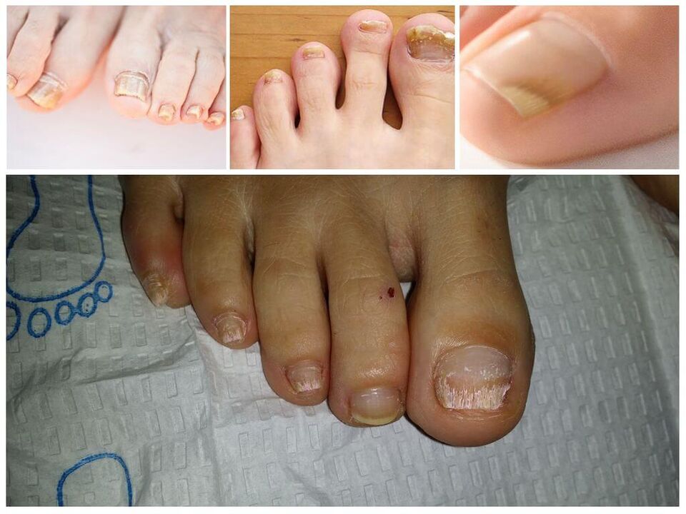 Choroby grzybicze płytek paznokciowych