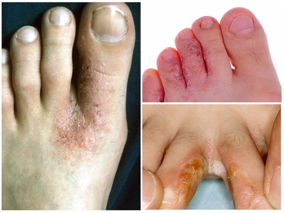 Grzybica międzypalcowa