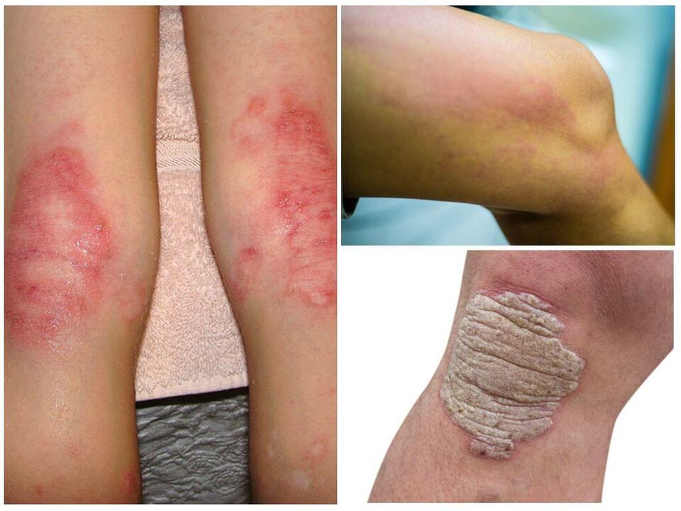 Infekcje grzybicze kolan