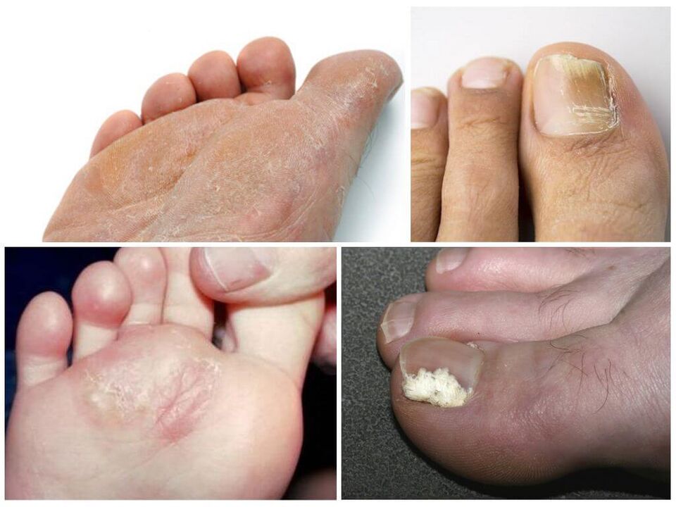 Początkowy etap grzybicy stóp