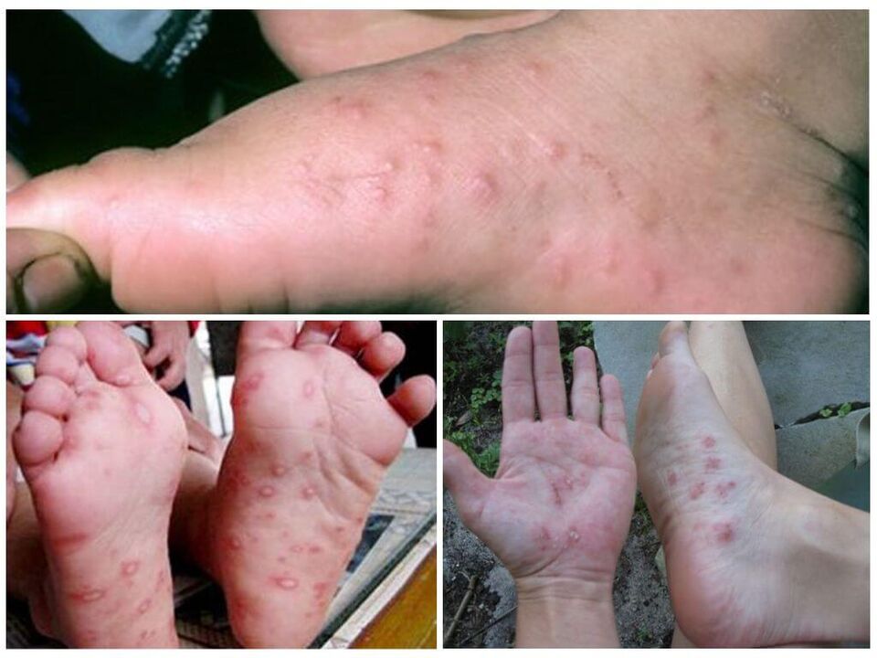 Zmiany hiperkeratotyczne stóp