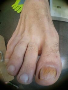 grzyb paznokci u dużego palca