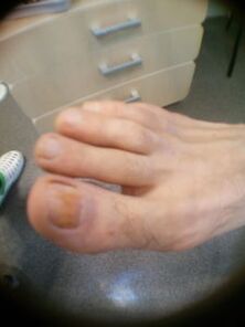 początkowe stadium grzybicy paznokci dużego palca