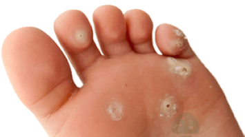 drugi etap infekcji grzybiczej