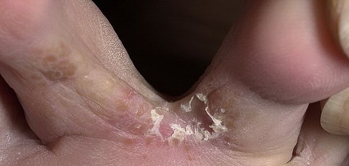 grzyb między palcami