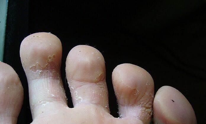 początkowe stadium grzyba