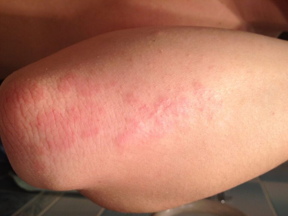 Reakcja alergiczna w postaci wysypki na skórze łokcia po nałożeniu kropli soku z glistnika